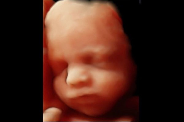 3 ve 4 Boyutlu Ultrason