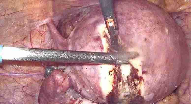 Adenomiyozis: Sık Görülen Bir Kadın Hastalığı