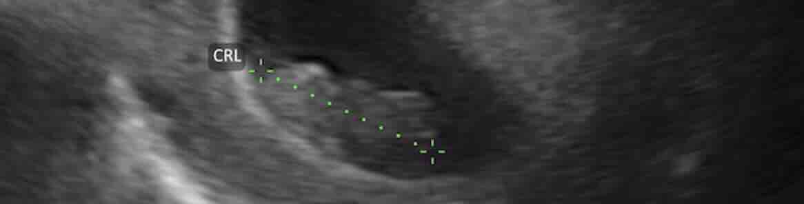 Adet Düzensizliklerinde Gebelik Haftası Hesaplama