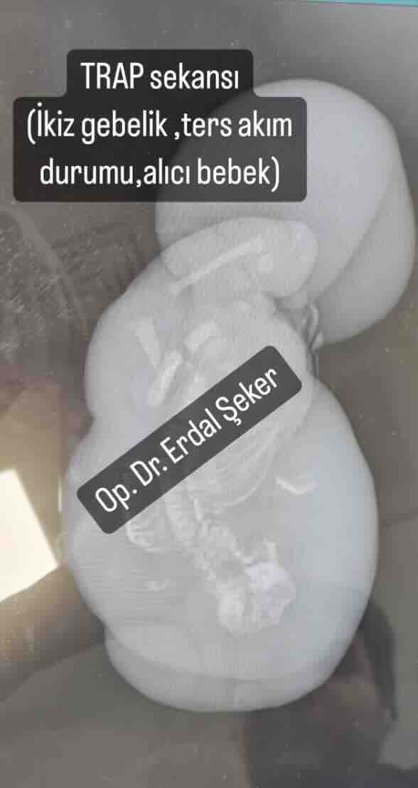 Akardiyak İkiz (TRAP Sekansı): 