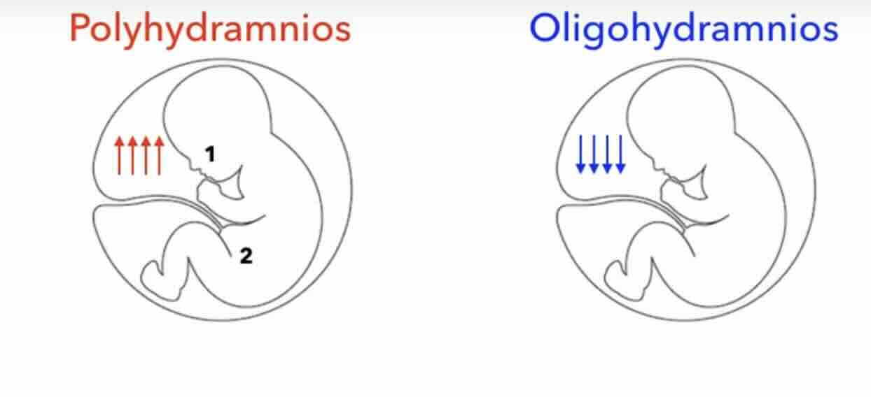 AMNİYON SIVI AZLIĞI (OLİGOHİDROAMNİYOS)