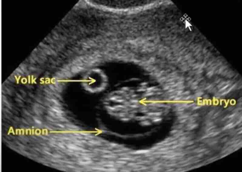 AMNİYON SIVISI GELMESİ: NEDİR, NEDEN OLUR, NASIL ANLAŞILIR?