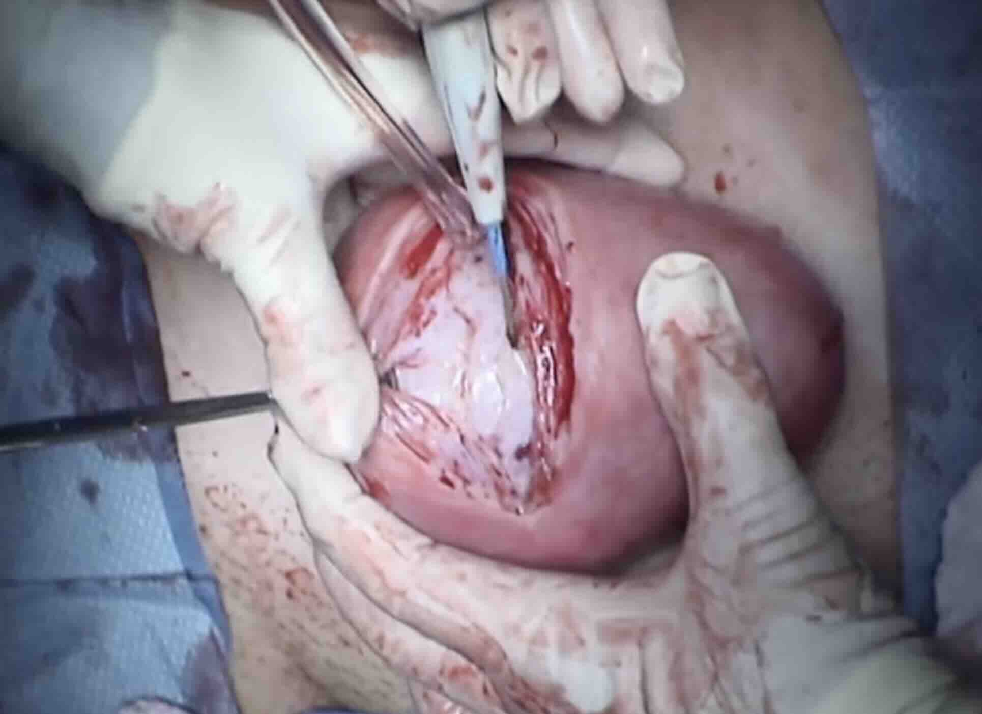 Ankara'da Miyom Ameliyatı (Miyomektomi)