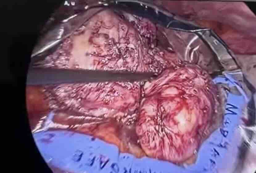 Ankara Myom Ameliyatı 2026