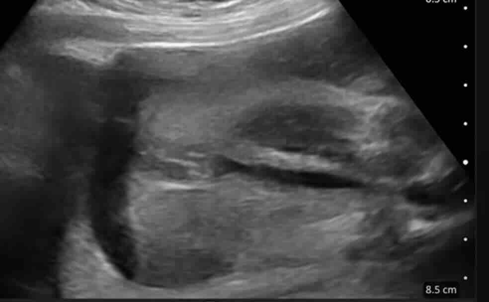 Bebek Cinsiyeti Ne Zaman Belli Olur?