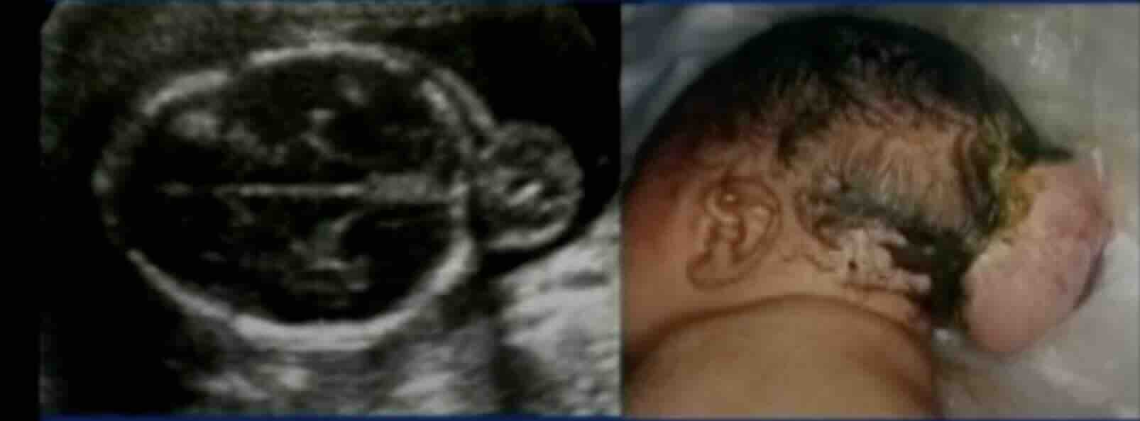 Bebekler Neden Engelli Olur?