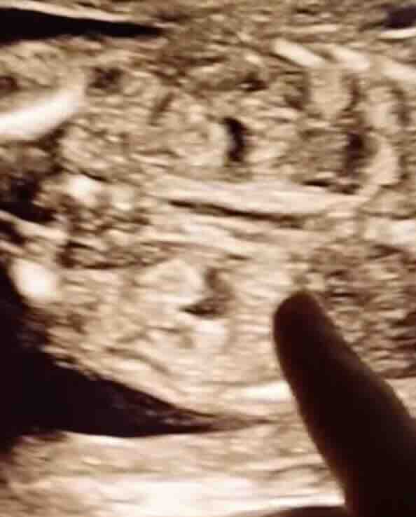 BEBEKLERDE ANNE KARNINDA BÖBREK GENİŞLEMESİ