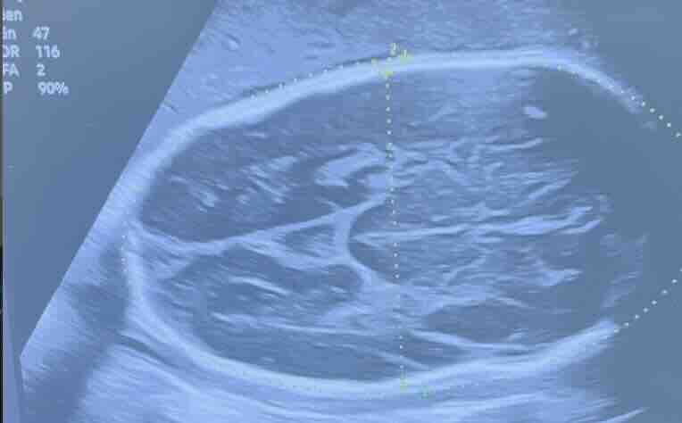 Bebeklerde Kafa Şekli Bozuklukları