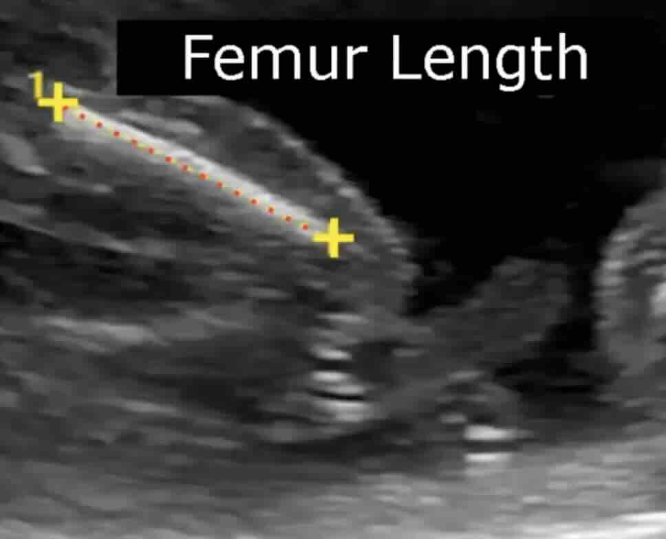 Bebekte Bacak ve Kol Kısalığı Nedir? Down Sendromu ile İlişkisi Var mı?