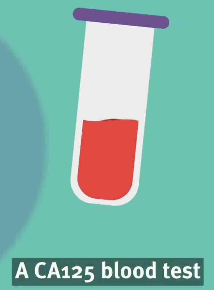 CA 125 Nedir?