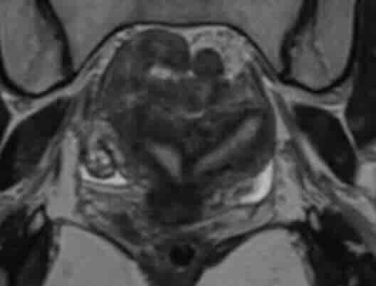 Çift Rahim (Uterus Didelphys) Nedir? 