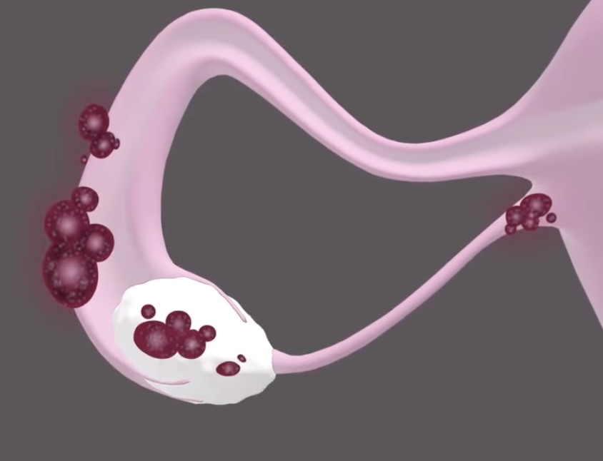 Çikolata Kisti Ne Zaman Ameliyat Edilmeli?