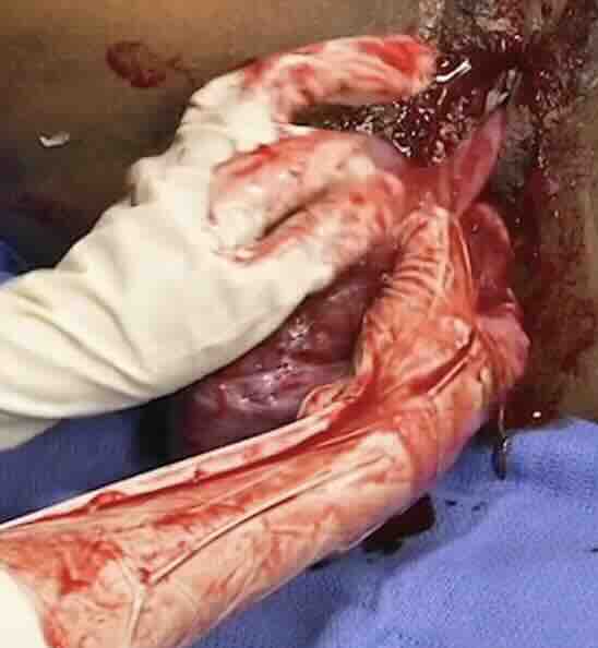 Çocuk Aldırmanın Riskleri (Kürtaj)