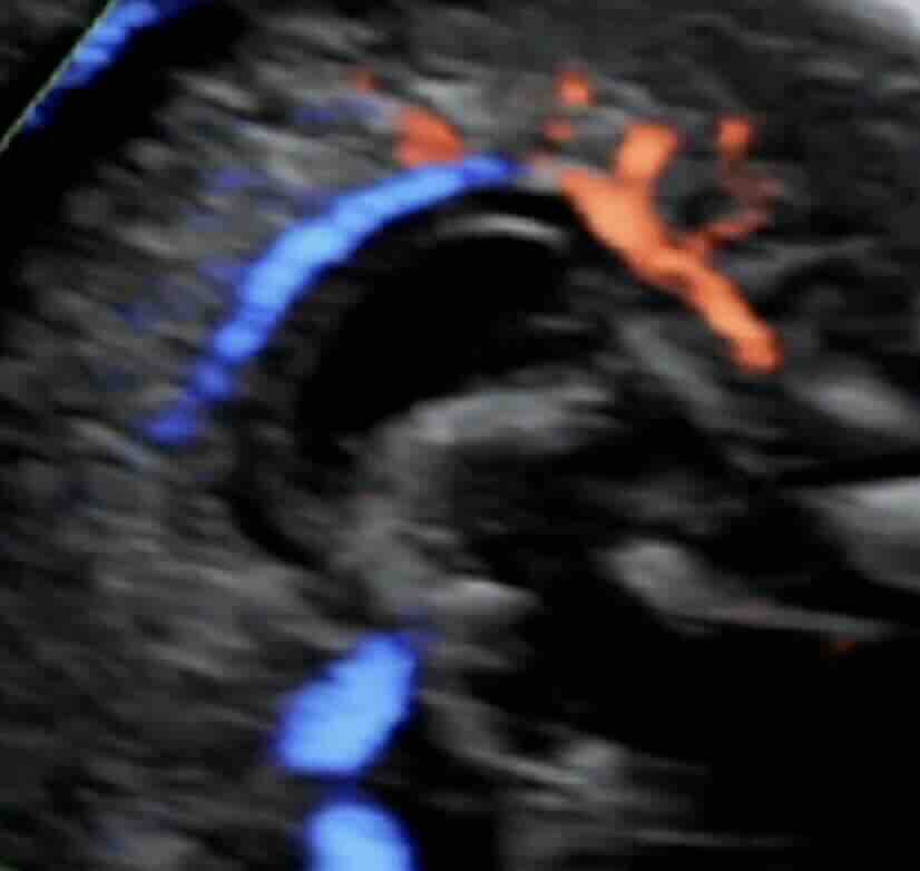 Corpus Callosum Nedir?