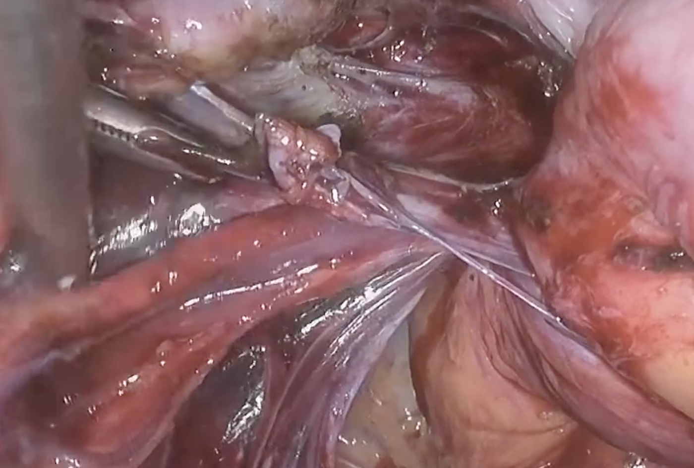 Derin İstilacı Endometriozis 