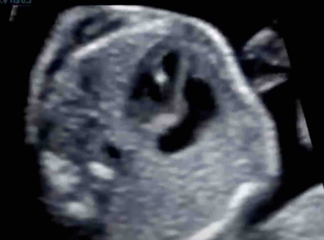 Detaylı Ultrasonda Kalpte Parlaklık (Ekojen Odak) Nedir?