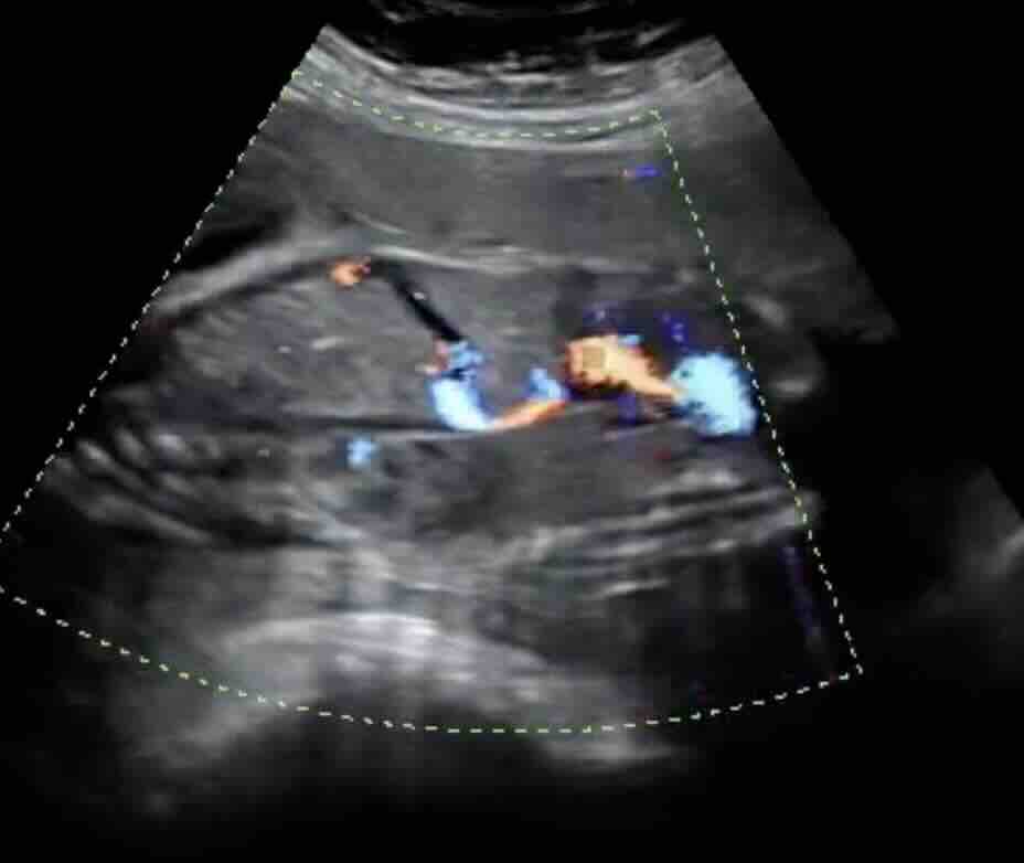 Duktus Venosus Nedir? Gebelikte Önemi