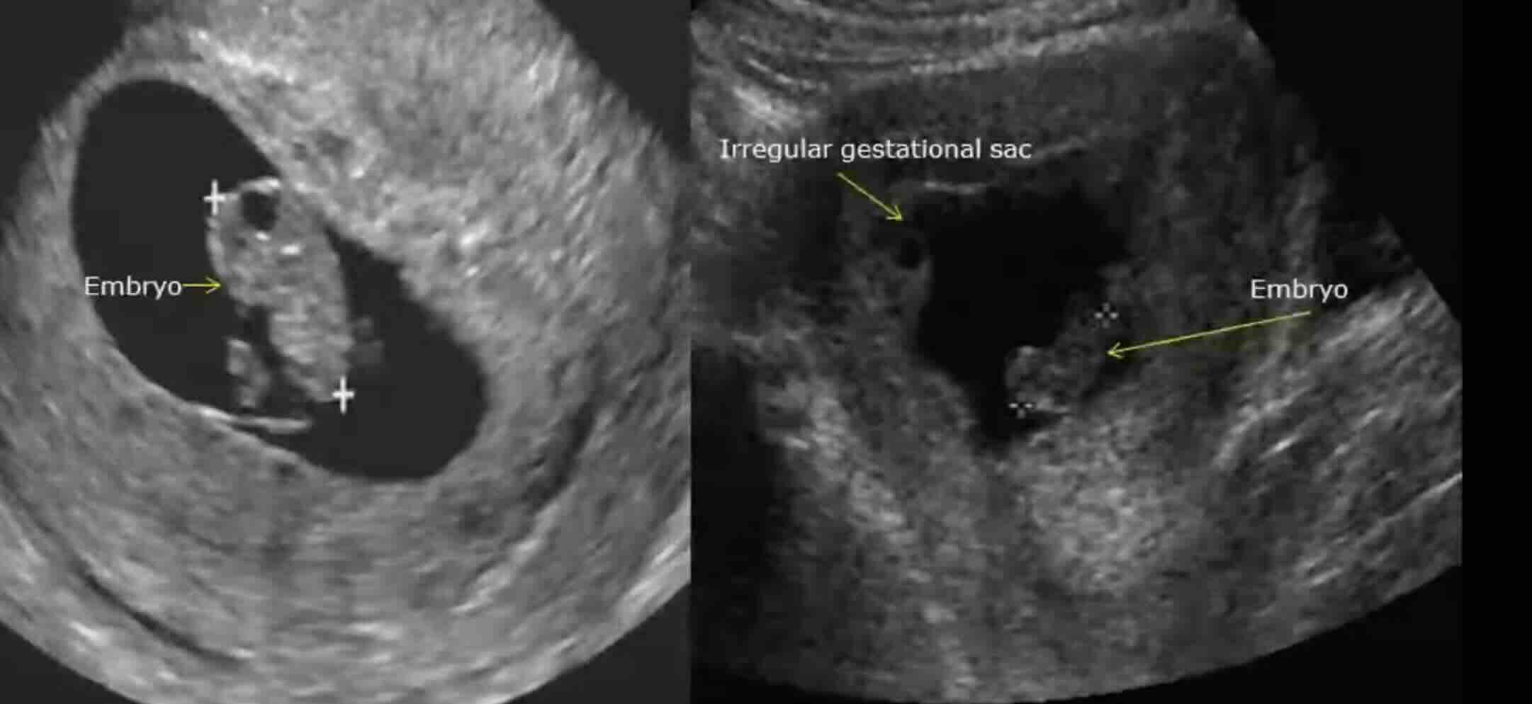 Düşük Sonrası Yapılacak Tetkikler ve Araştırmalar: Neden, Ne Zaman, Nasıl Yapılır?