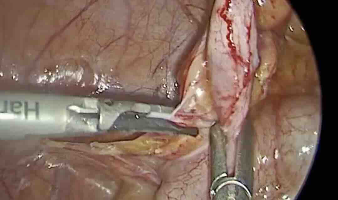 Endometriozis