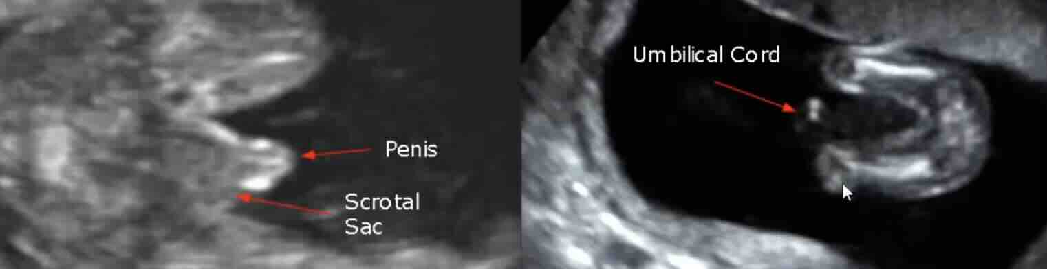 Erkek Bebek mi Kız Bebek mi?