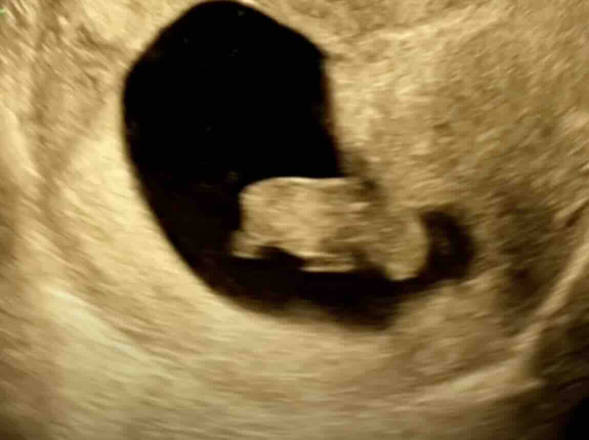 Erken Gebelik Kaybı (Düşük) Nedir? Belirtileri, Tanı Kriterleri ve Tedavi Seçenekleri