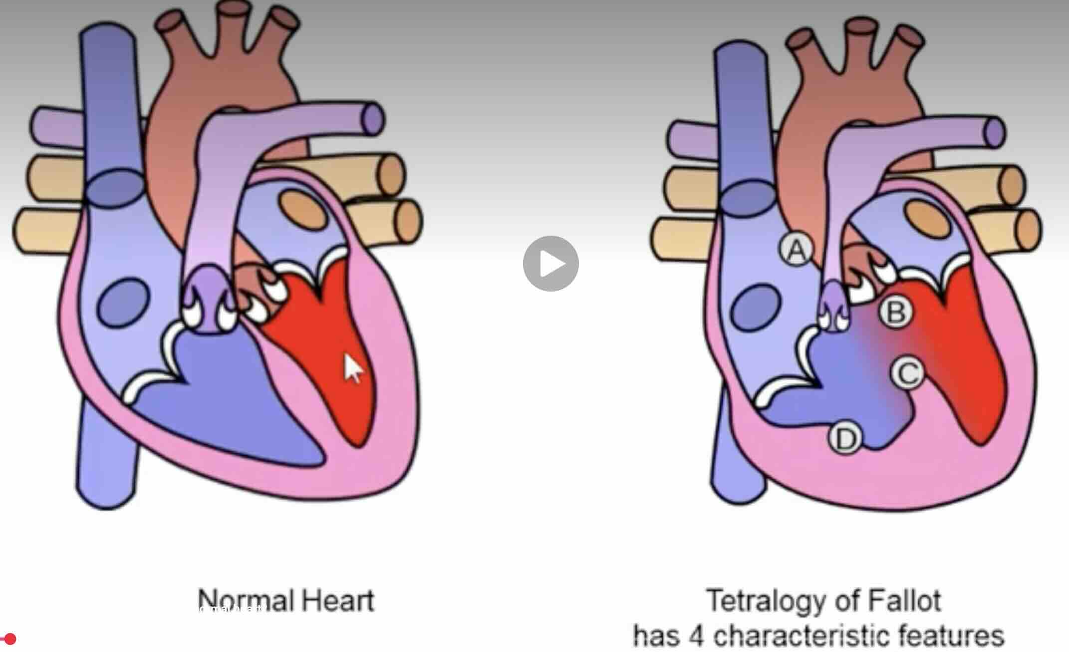 Fallot Tetralojisi Nedir?