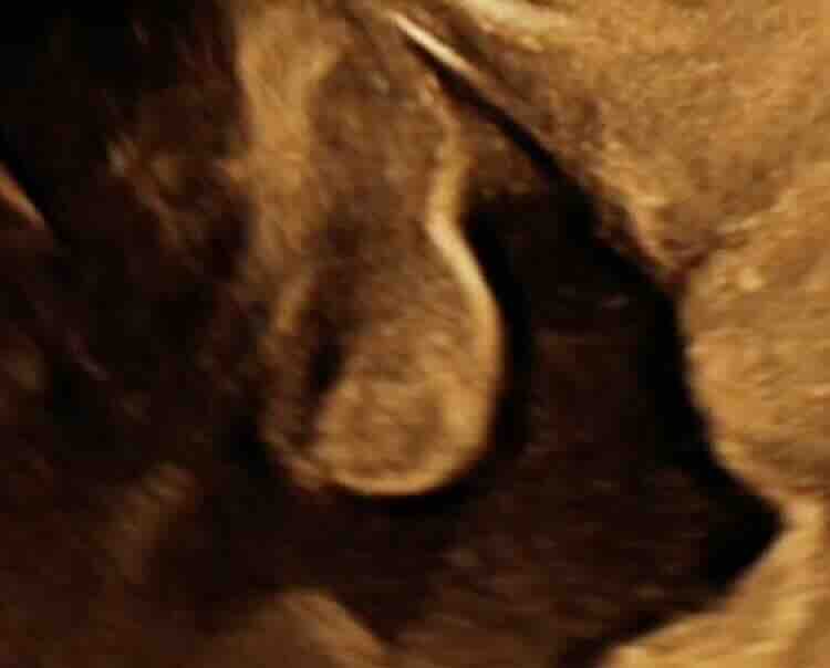 Fetal Ambigus Genitalya (Belirsiz Cinsel Organ Gelişimi) Nedir?