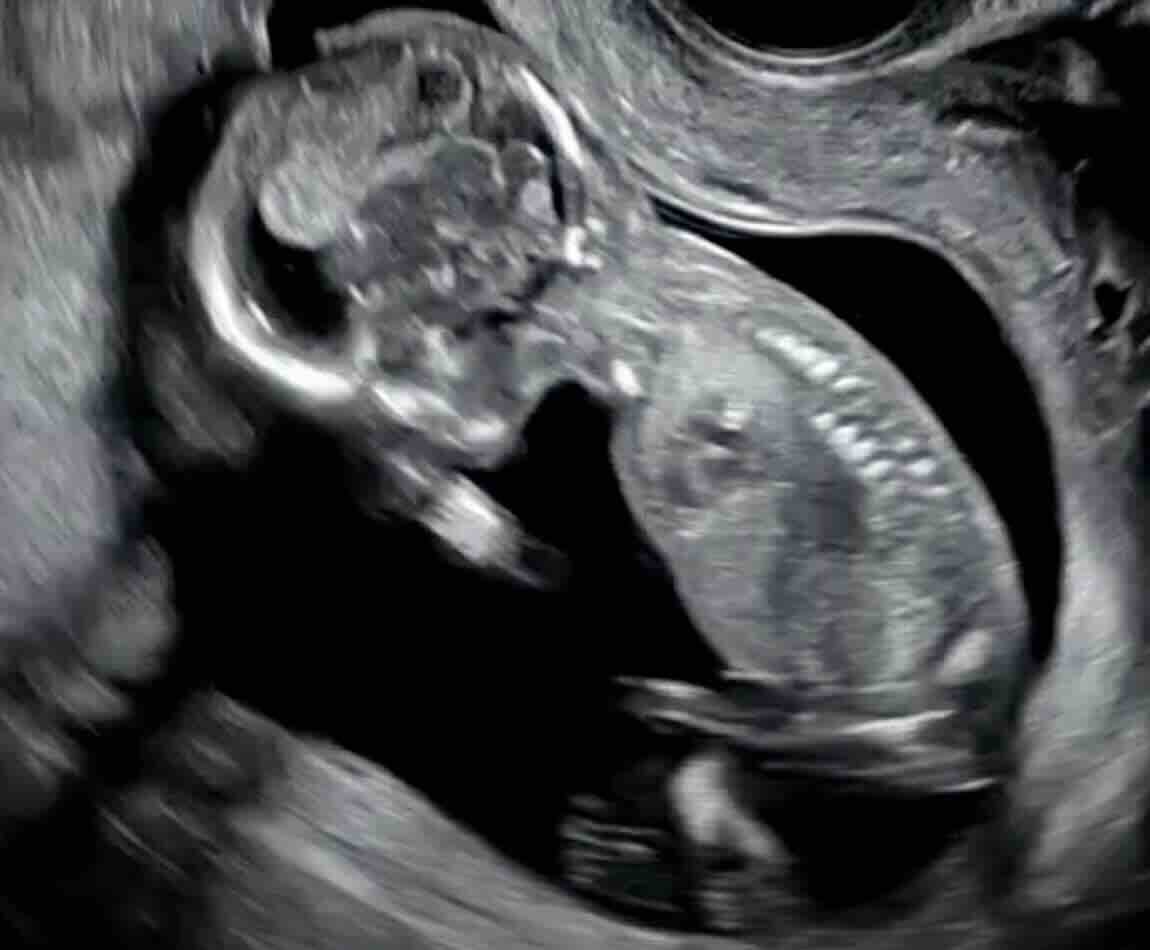 FETAL DNA’DA CİNSİYET YANILMASI: NEDEN OLUR, NASIL ANLAŞILIR?