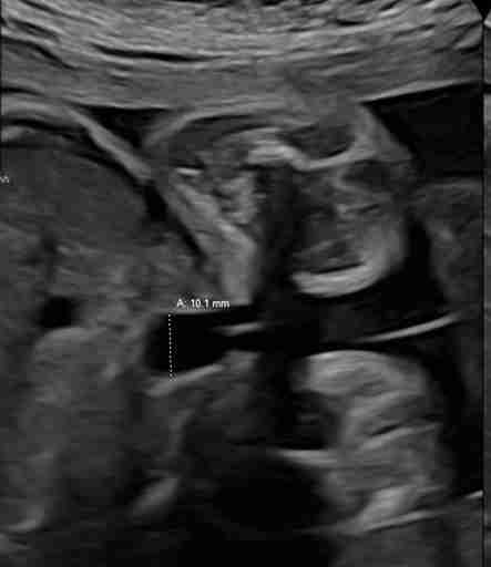 Fetal Eko (Kalp Taraması)
