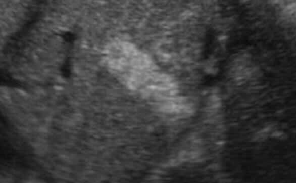 Fetal Kistik Fibrozis