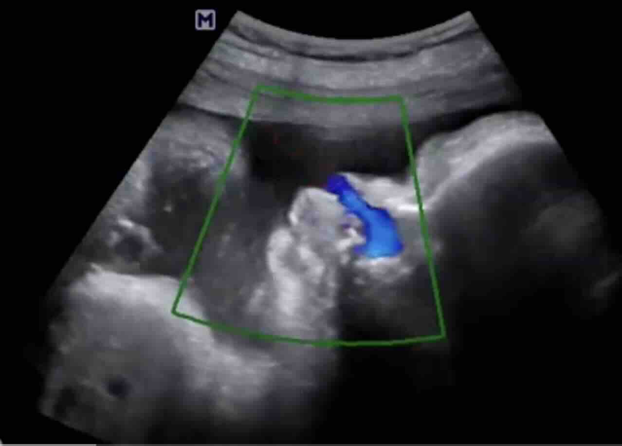 Fetal Stres: Anne Karnındaki Bebeğinizin Sessiz Çığlığına Kulak Verin