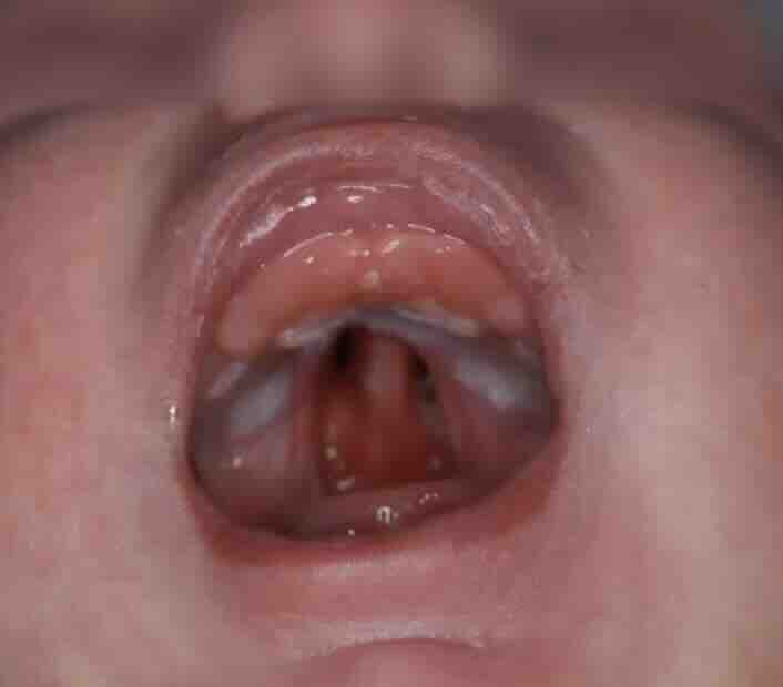 Fetal Yarık Dudak ve Damak 