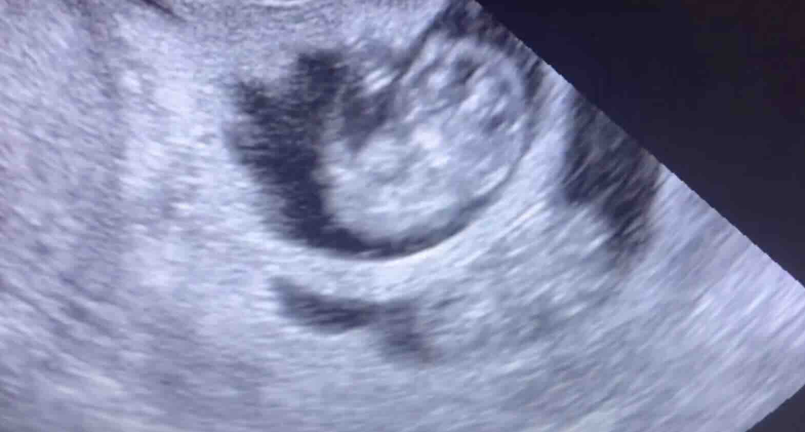 Fetosid ve Selektif Redüksiyon: Çoğul Gebeliklerde ve Ciddi Durumlarda Gebelik Yönetimi