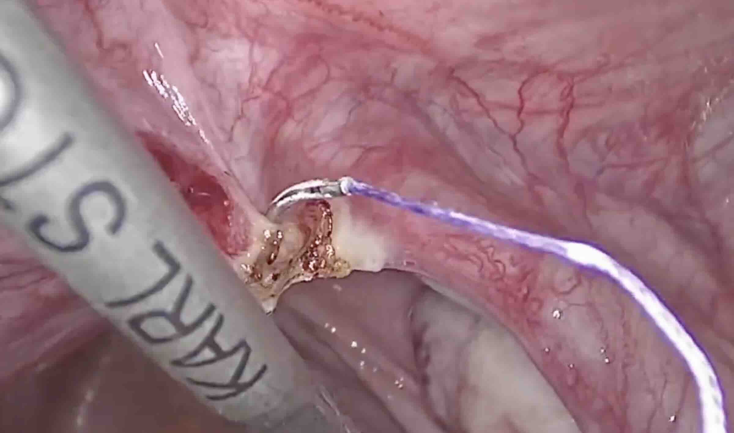 Gebelik Hayali Yeniden Canlanıyor: Ankara'da Tüp Açma Ameliyatı (Tubal Reanastomoz) 2025