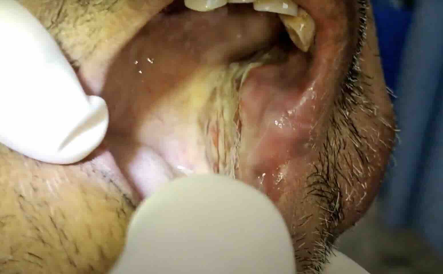 Gebelikte Ağızda Yaralar Neden Olur?