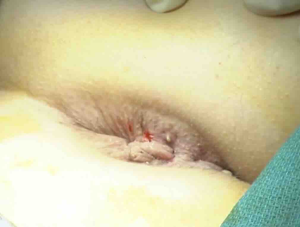 Gebelikte Hemoroid (Basur)