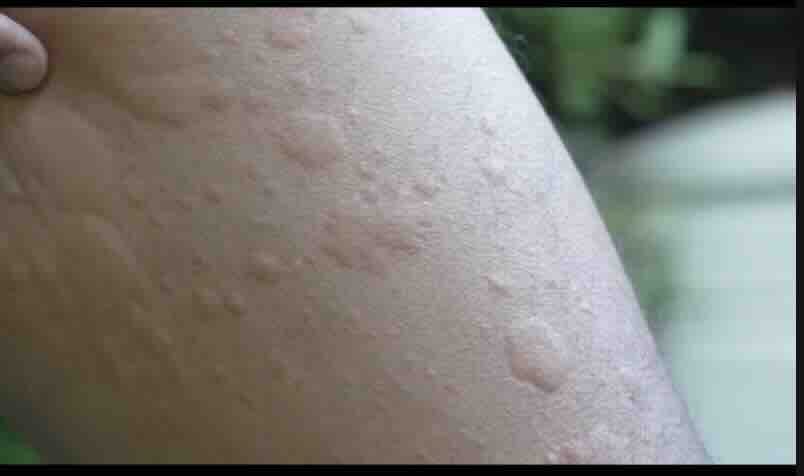 Gebelikte Kaşıntı, Ürtiker ve Steroid Kullanımı