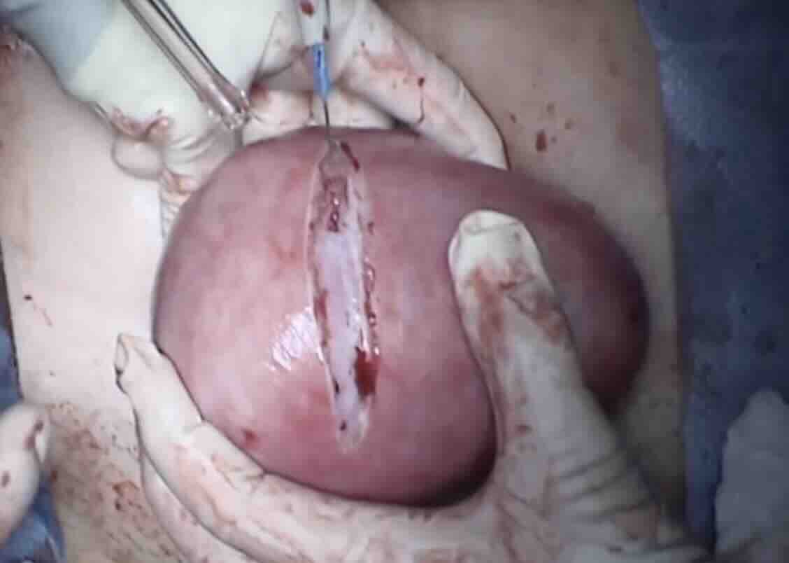 Gebelikte Myom: Belirtileri, Riskleri, Tedavisi ve Takibi