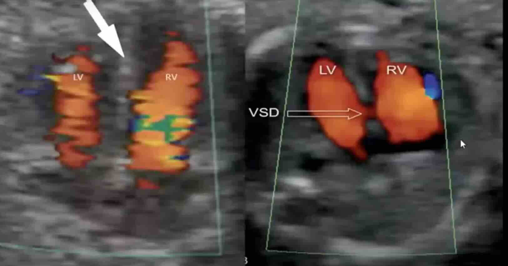 GEBELİKTE RENKLİ ULTRASON (DOPPLER ULTRASON) – ANKARA PERİNATOLOJİ