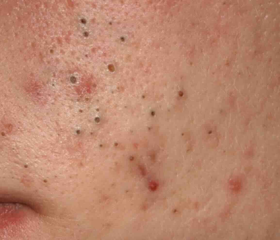 Gebelikte Teratojenik İlaç Kullanımı ve İlaç Güvenliği