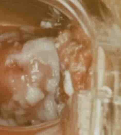 Geçmeyen Vajinal Mantar Tedavisi