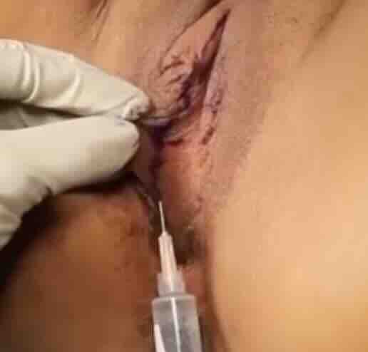 Genital PRP