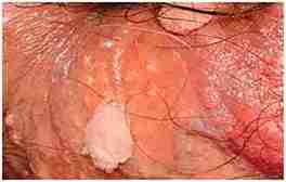 Genital Siğiller (HPV)