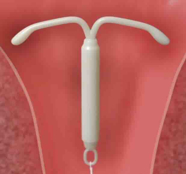 Hormonlu Spiral Nedir? Kullanımı ve Yan Etkileri