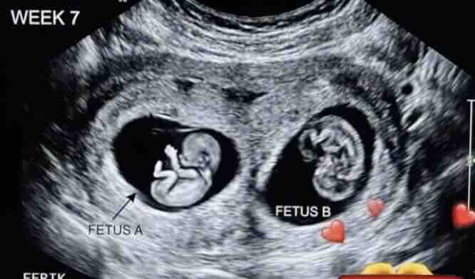 İkiz Eşi Ex Fetus Nedir?