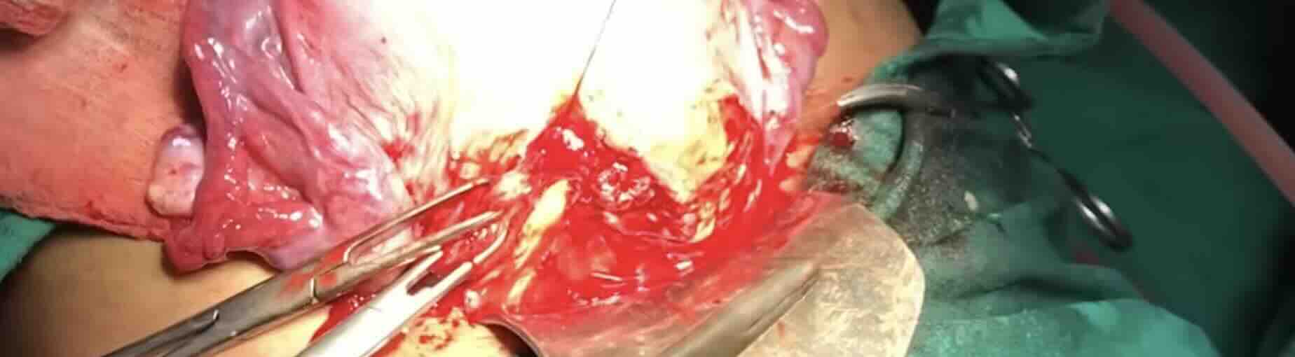 Kaç Defa Sezaryen Olunabilir?