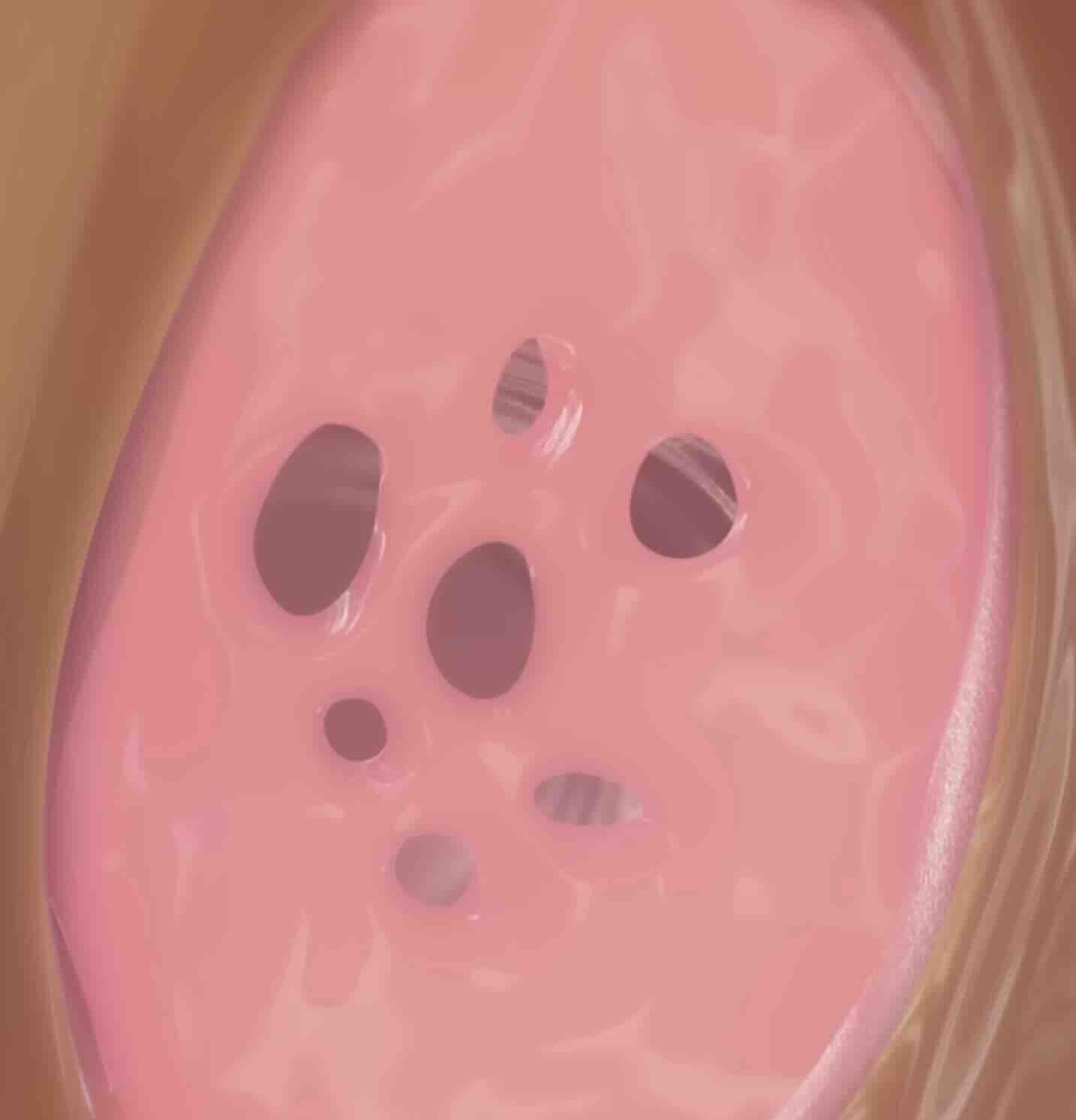 Kalıcı ve Geçici Kızlık Zarı Dikimi (Himenoplasti)