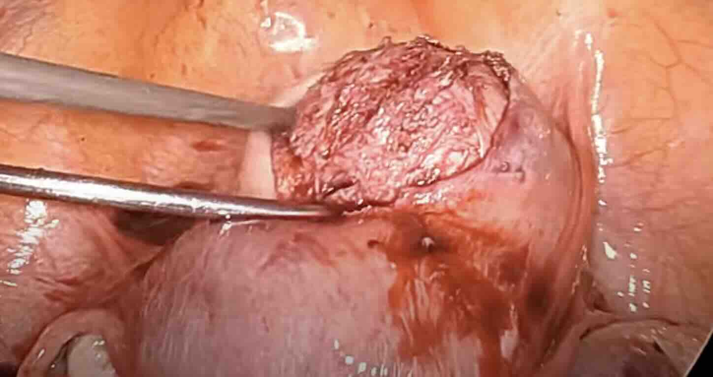 Kapalı Myom Ameliyatı (Laparoskopik Myomektomi)