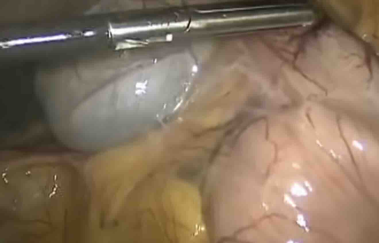 Kapalı Rahim Alma Ameliyatı (Laparoskopik Histerektomi) Ankara