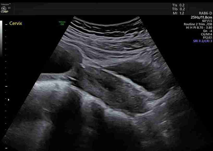  Karından (Abdominal) Serklaj: Rahim Ağzı Yetmezliğinde Umut Işığı